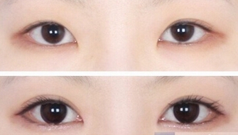 开眼角手术后该怎么护理