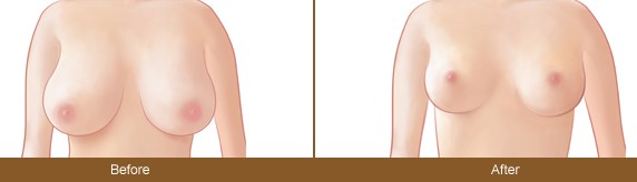 巨大乳房缩小术的步骤是什么 巨大乳房缩小术前后对比图