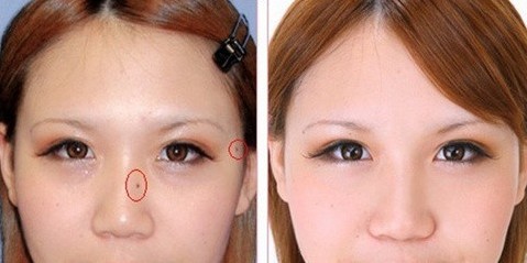 点痣后要注意什么 点痣后如何护理