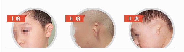 关于耳朵再造术的知识