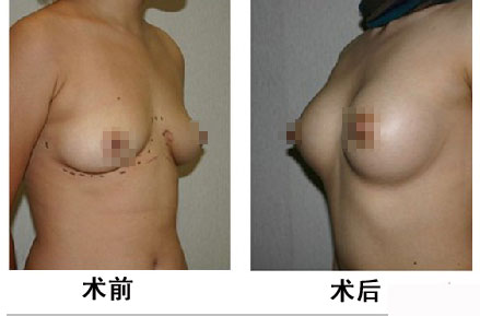 硅胶假体隆胸手术怎么样