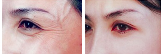 注射瘦脸祛鱼尾纹果怎么样