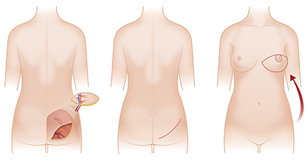 乳房再造成就**女人