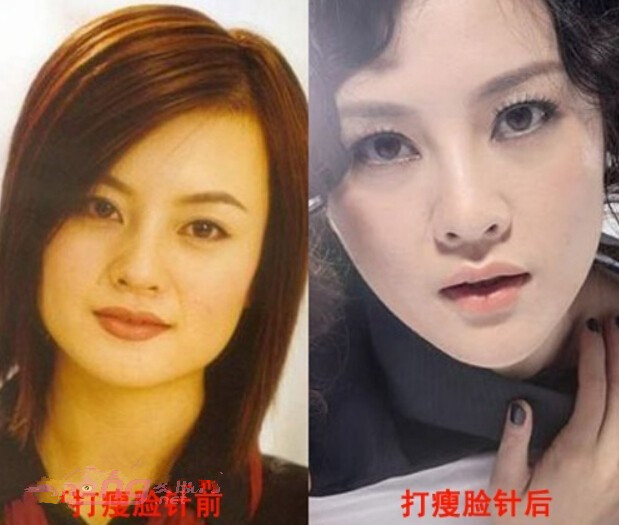【B****前后对比图】揭秘娱乐圈女星打B****前后对比图