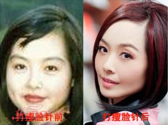 【B****前后对比图】揭秘娱乐圈女星打B****前后对比图