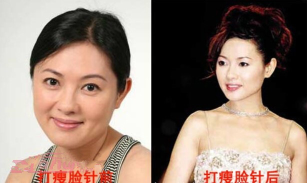 【B****前后对比图】揭秘娱乐圈女星打B****前后对比图
