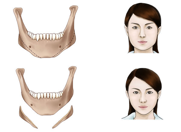 女人尖下颌角整形手术怎么样 女人尖下颌角整形手术前后对比图
