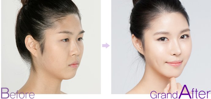 三点式双眼皮多少钱 三点式双眼皮前后对比图