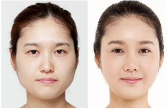 生物焊接双眼皮价格多少钱 生物焊接双眼皮前后对比图