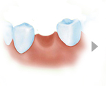 微创种植牙的手术过程介绍