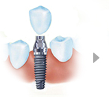 微创种植牙的手术过程介绍