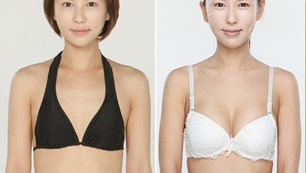 娜高假体隆胸多少钱 娜高假体隆胸案例