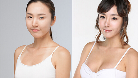娜高假体隆胸多少钱 娜高假体隆胸案例