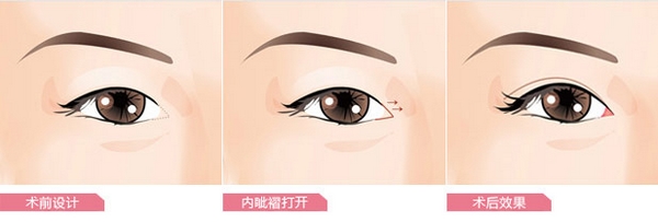 开外眼角的价格多少钱 开外眼角有哪些注意事项