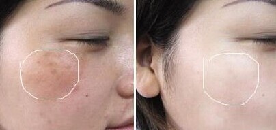 复合彩光去粉刺有什么优势 复合彩光去粉刺果怎么样