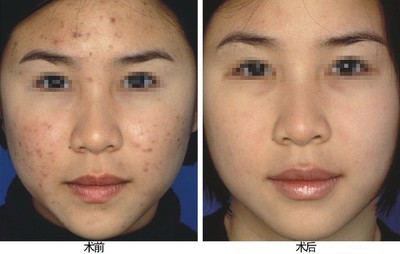 复合彩光去粉刺有什么优势 复合彩光去粉刺果怎么样