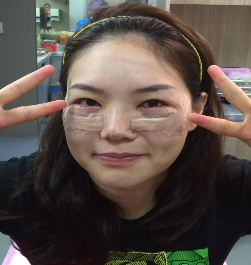 眼袋去除手术,一下年轻了十岁