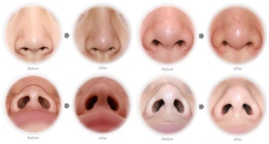 鼻孔缩小手术对比图,鼻孔缩小手术