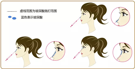 手术整形,微整形