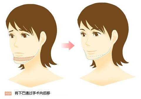 手术整形,微整形