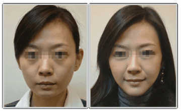 韩式微创改脸型手术价格