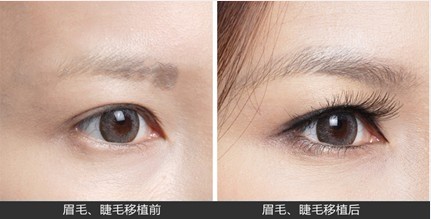 嫁接睫毛过敏肿痛痒是怎么回事?(图1)