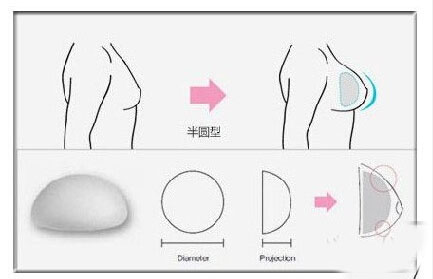 隆胸丰胸_丰胸哪里好_丰胸的价格