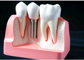 种植牙,术后,如何护理