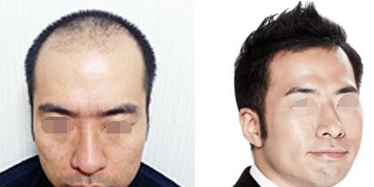 头发种植手术降低风险吗
