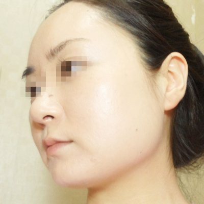 韩国那木下颌角截骨手术恢复过程分享_三元整