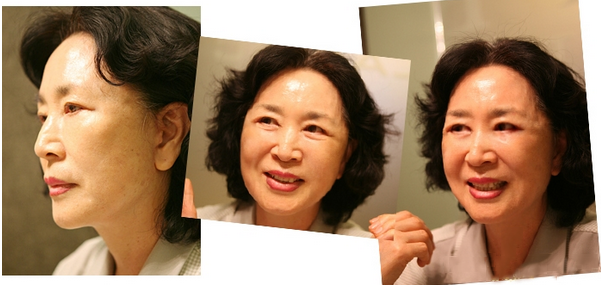 拉皮除皱手术让我年轻20岁