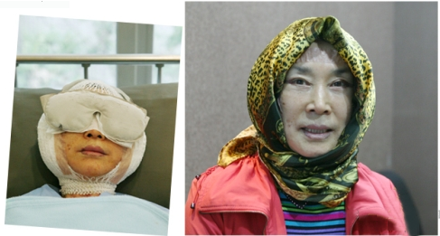 拉皮除皱手术让我年轻20岁