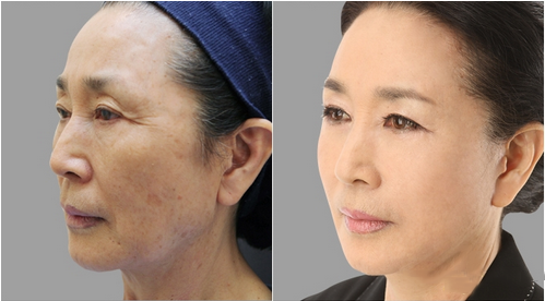 拉皮除皱手术让我年轻20岁