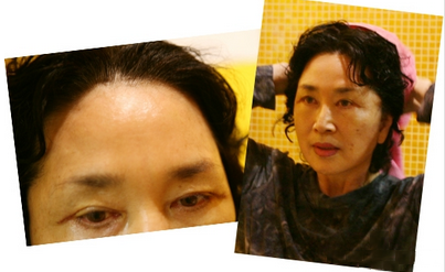 拉皮除皱手术让我年轻20岁