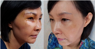 做了电波l皮除皱年轻了十多岁 杭州同欣做的很不错哦