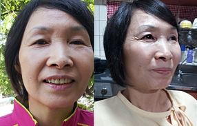 做了电波l皮除皱年轻了十多岁 杭州同欣做的很不错哦