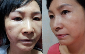 做了电波l皮除皱年轻了十多岁 杭州同欣做的很不错哦