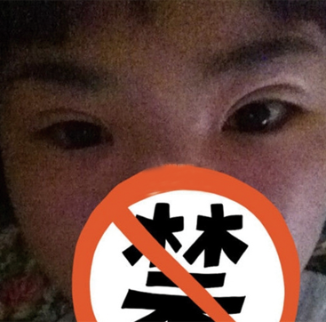 双眼皮修复成功辣  再也不用担心异样的眼光辣