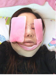 为大家分享我在北京301医院做下颌角整形的真实历程
