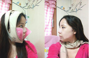 为大家分享我在北京301医院做下颌角整形的真实历程