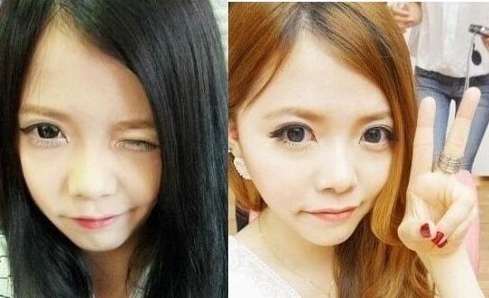 硅胶隆鼻手术圆了我高鼻梁的梦