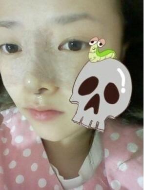 硅胶隆鼻手术圆了我高鼻梁的梦