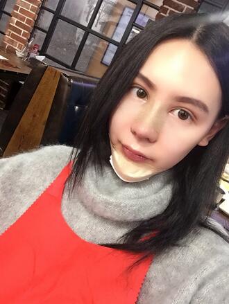 成都天使之翼做隆鼻整形改变了我的塌鼻子 果真的很不错