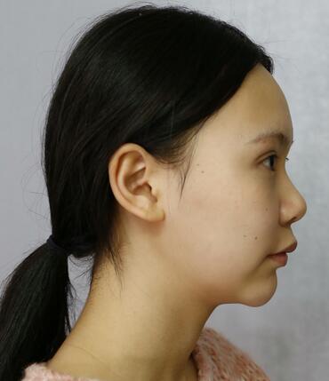 成都天使之翼做隆鼻整形改变了我的塌鼻子 果真的很不错