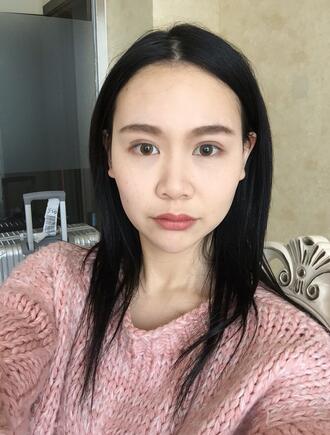 成都天使之翼做隆鼻整形改变了我的塌鼻子 果真的很不错