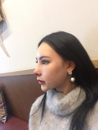 成都天使之翼做隆鼻整形改变了我的塌鼻子 果真的很不错
