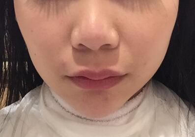 成都天使之翼做隆鼻整形改变了我的塌鼻子 果真的很不错