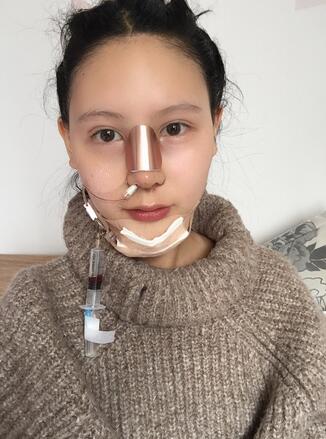 成都天使之翼做隆鼻整形改变了我的塌鼻子 果真的很不错
