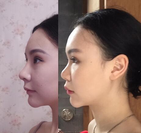 成都天使之翼做隆鼻整形改变了我的塌鼻子 果真的很不错