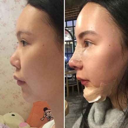 成都天使之翼做隆鼻整形改变了我的塌鼻子 果真的很不错